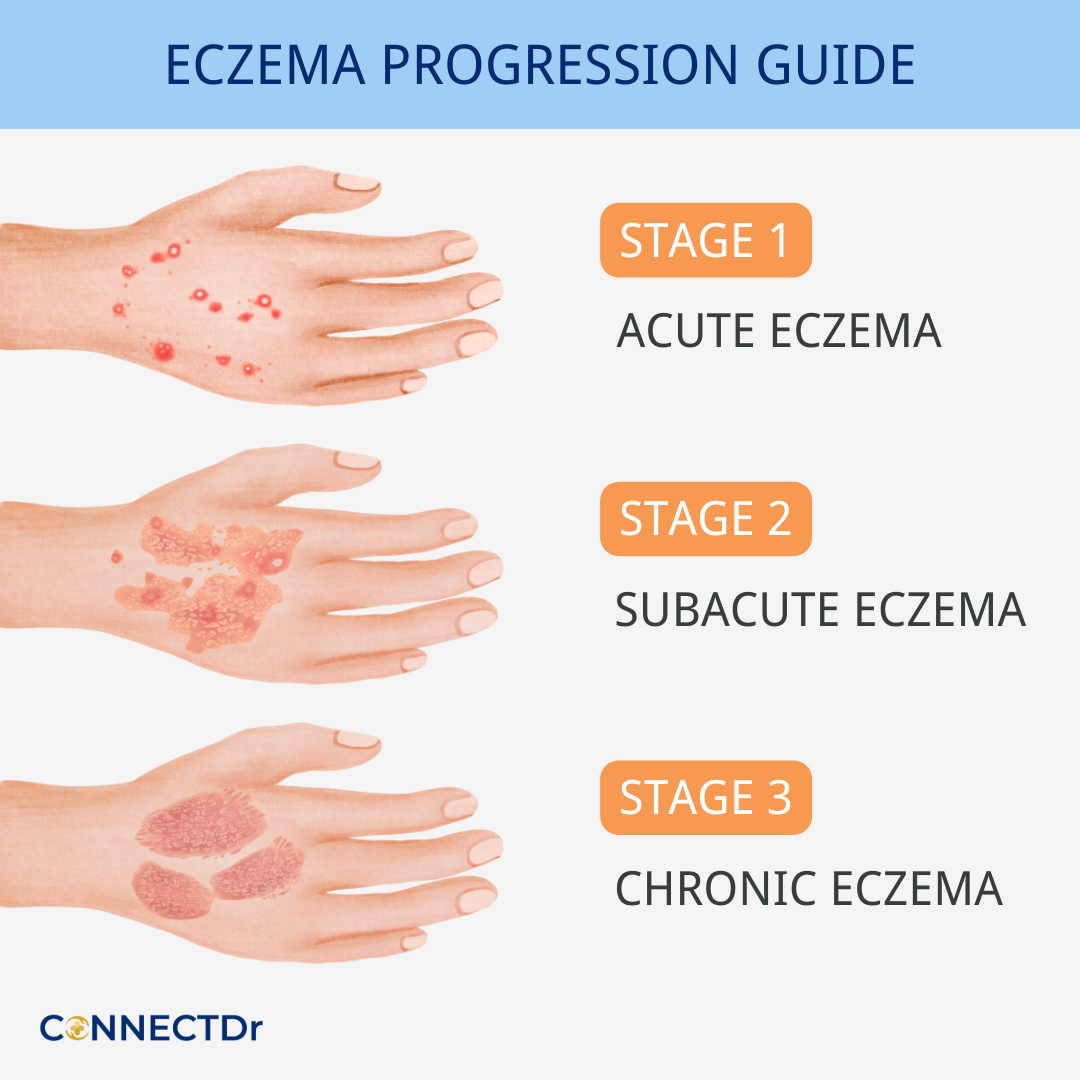 Varicose Eczema Treatment Stages Symptoms And More FXMET
